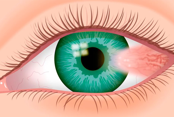 Cirurgia para retirada de Pterígeo